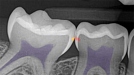 x-ray with Overjet AI