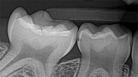 x-ray without Overjet AI